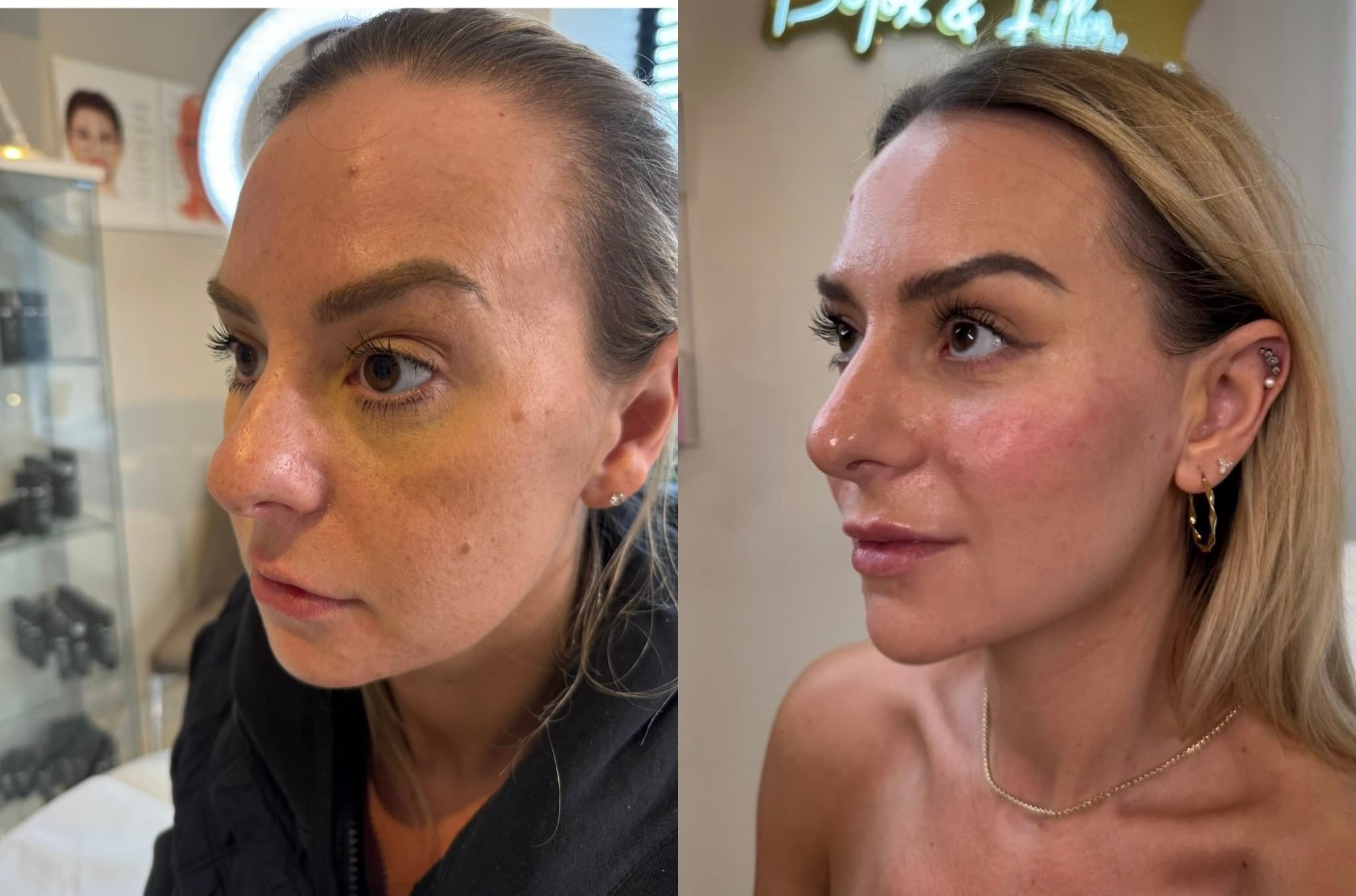 Non-Surgical Facelift