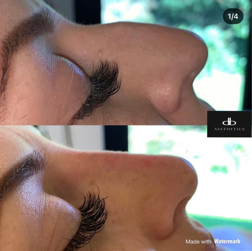 Non-Surgical Rhinoplasty