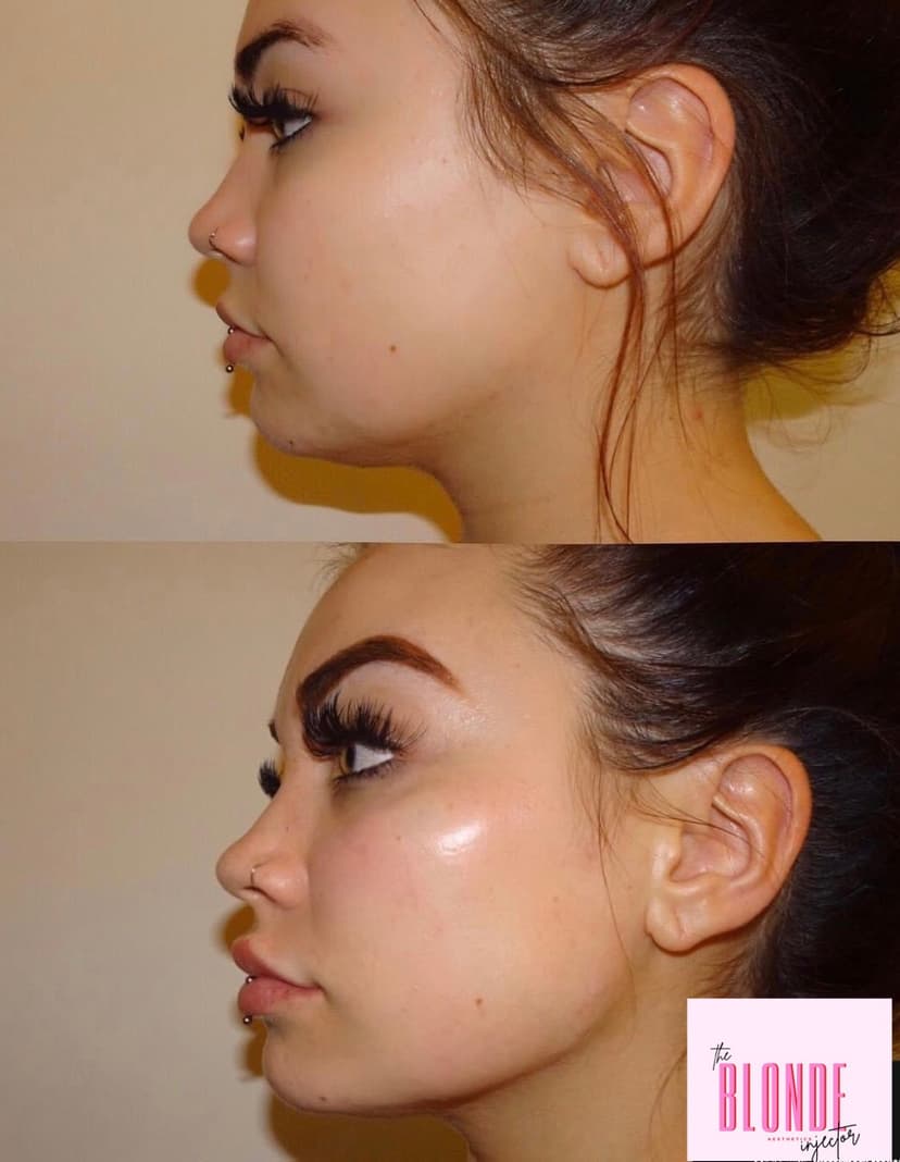 Dermal Fillers