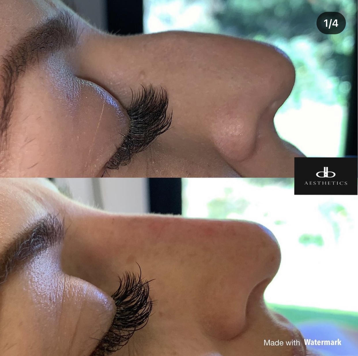 Non-Surgical Rhinoplasty